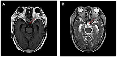 Case Report: Hypopituitarism Presenting With Nonconvulsive Status Epilepticus